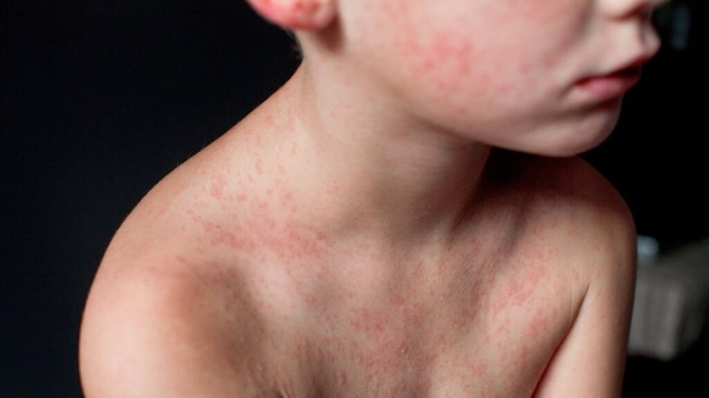 Aantal gevallen van mazelen neemt toe, deze week 50 nieuwe infecties
