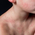 Aantal gevallen van mazelen neemt toe, deze week 50 nieuwe infecties