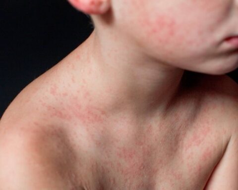 Aantal gevallen van mazelen neemt toe, deze week 50 nieuwe infecties