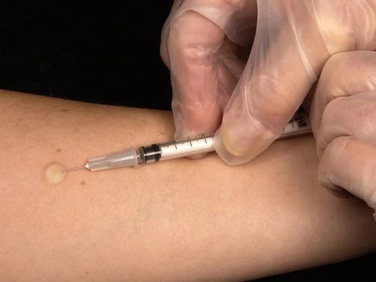 Uitbraak van tuberculose onder dak- en thuislozen in Arnhem vastgesteld