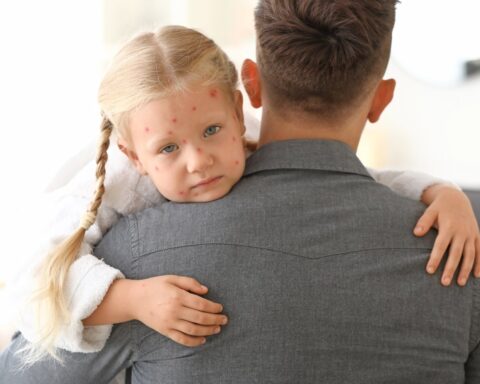 Aantal griepgevallen blijft dalen, maar waterpokken infecties nemen snel toe, zeggen gezondheidsfunctionarissen