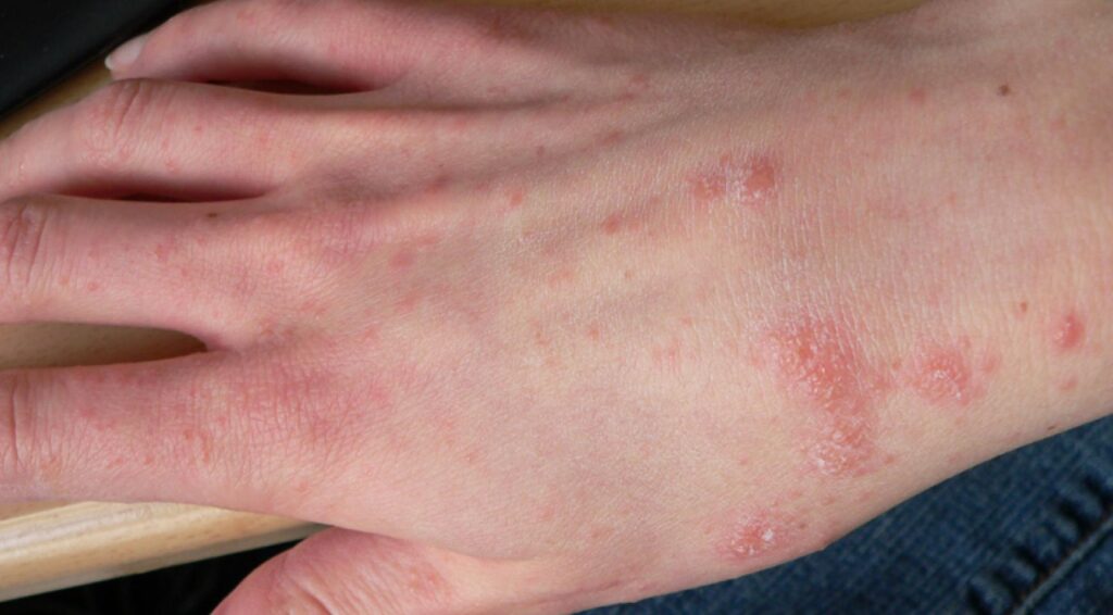 Aantal schurftgevallen stijgt in Nederland, vooral in kinderdagverblijven en verpleeghuizen