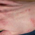 Aantal schurftgevallen stijgt in Nederland, vooral in kinderdagverblijven en verpleeghuizen