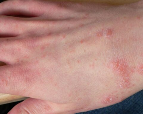 Aantal schurftgevallen stijgt in Nederland, vooral in kinderdagverblijven en verpleeghuizen