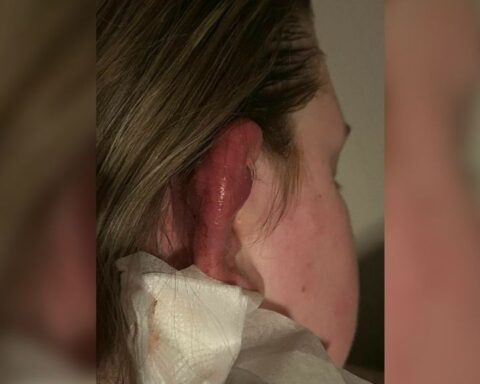 Meer dan 150 meldingen van infecties door besmette piercingspray uit Coevorden