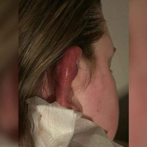 Meer dan 150 meldingen van infecties door besmette piercingspray uit Coevorden