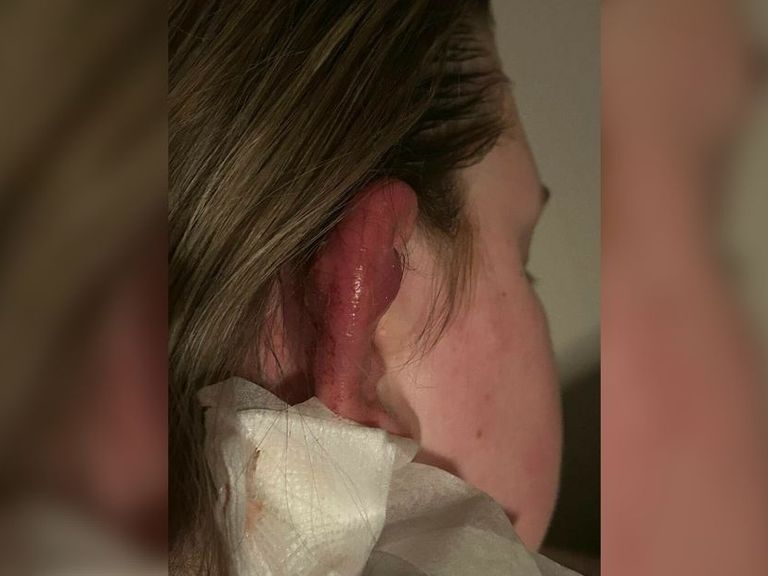 Meer dan 150 meldingen van infecties door besmette piercingspray uit Coevorden