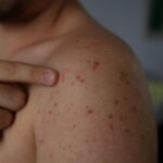 Nederlandse reiziger brengt eerste mazelengeval naar Panama sinds 1995