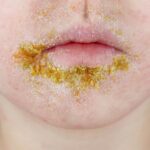 Sterke stijging van impetigo-gevallen onder Nederlandse kinderen eerder dan gebruikelijk
