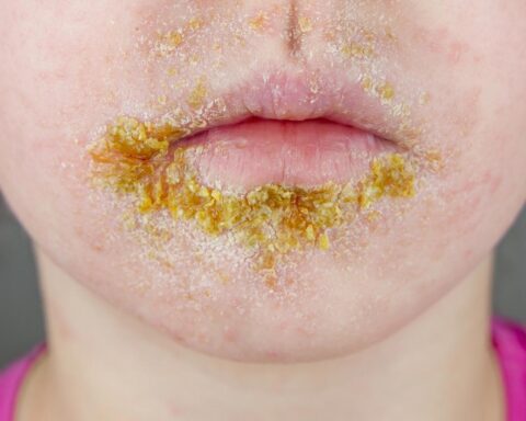 Sterke stijging van impetigo-gevallen onder Nederlandse kinderen eerder dan gebruikelijk