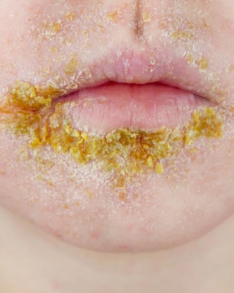 Sterke stijging van impetigo-gevallen onder Nederlandse kinderen eerder dan gebruikelijk